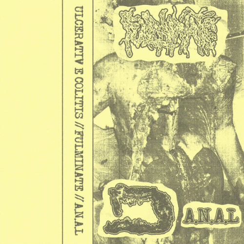 Fulminate : Ulcerative Colitis - Fulminate - A.N.A.L Fulminate : Ulcerative Colitis - Fulminate - A.N.A.L